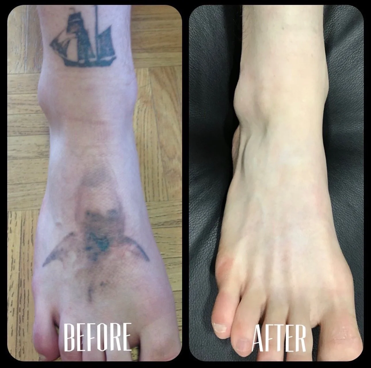 Comparison of a person's foot and ankle before and after treatment, with tattoos on the foot in the before image and a cleaner appearance in the after image.
