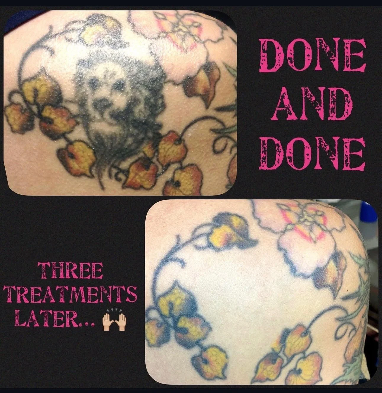 Comparison of a tattoo before and after three treatments, showing fading of floral tattoo with yellow and pink flowers.