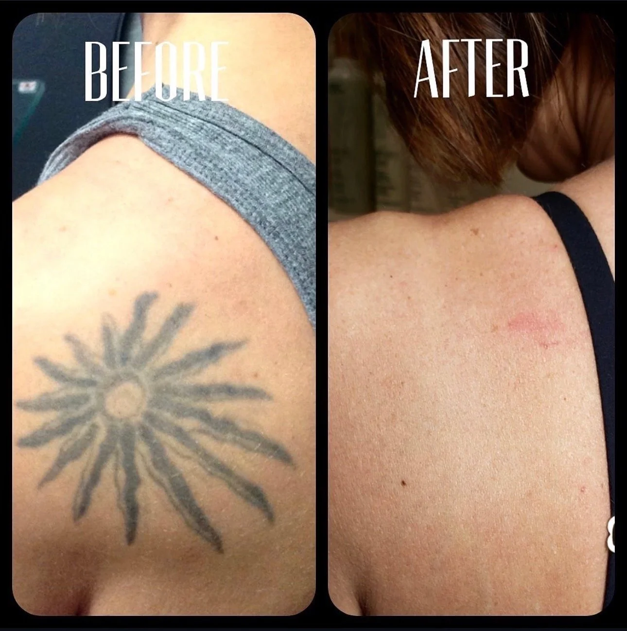 Side-by-side comparison showing a shoulder with a tattoo before and after a skincare treatment; the tattooed area appears clearer and the skin looks smoother after treatment.