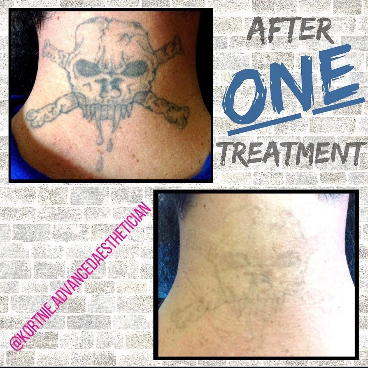 Comparison of a tattooed neck before and after tattoo removal treatment. The top image shows a skull and crossbones tattoo on the neck, while the bottom image shows the neck after tattoo removal, with significantly lighter skin and no visible tattoo.