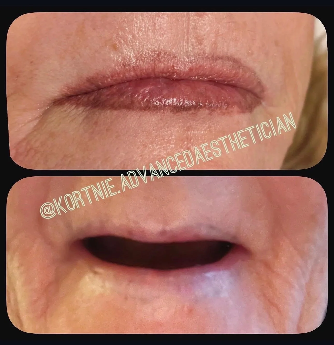 Close-up of a person's lips and mouth area, showing before and after cosmetic enhancement. The top image displays natural lips, while the bottom image shows the lips with significant augmentation or correction. The Instagram handle @KORTNE.ADVANCEDAE