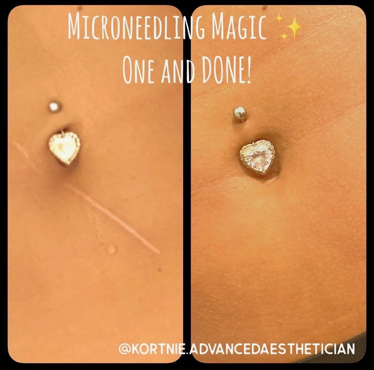 Close-up of a abdomen with two belly button piercings, one small and plain, and the other large and heart-shaped, with a diamond ring in the second piercing. Text overlay indicates it is a tutorial for micronedling magic, showing before and after res