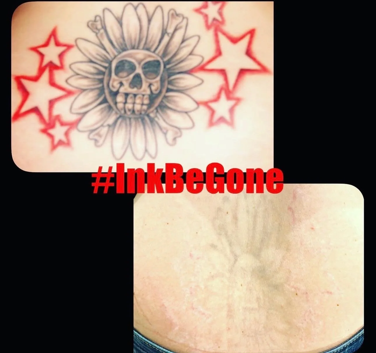 Tattoo of a skull face at the center of a sunflower with red stars around it. The tattoo is on a person's chest, with the hashtag #InkBeGone over it.