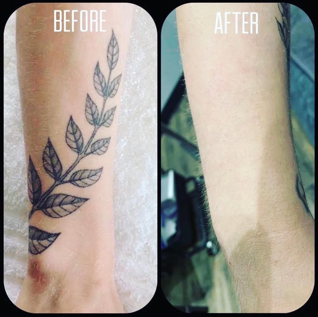 Comparison of a forearm with a black line art tattoo of a leafy branch on the left side labeled 'BEFORE,' and the same forearm with the tattoo removed and skin appearing clear on the right side labeled 'AFTER.'