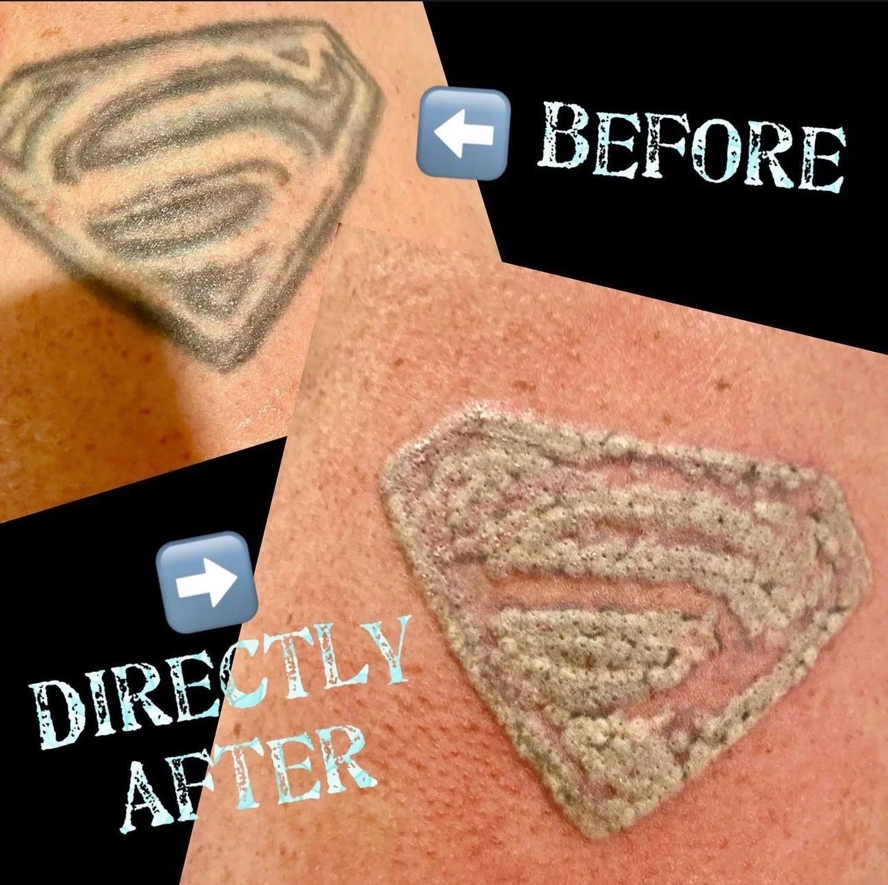 Comparison of a tattoo of the Superman logo before and after a sand covering, with labels 'Before' and 'Directly After'.