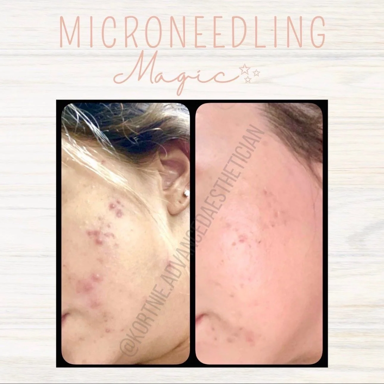 Before and after images showing skin improvements, labeled 'Microneedling Magic' on a light background.