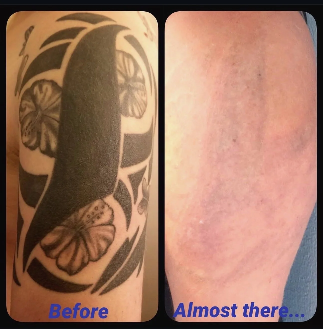 Close-up of a tattooed arm on the left with a butterfly design and black shading, and a bare arm on the right showing skin with some redness and minimal scars. The words 'Before' in blue at the bottom left and 'Almost there...' in blue at the bottom 