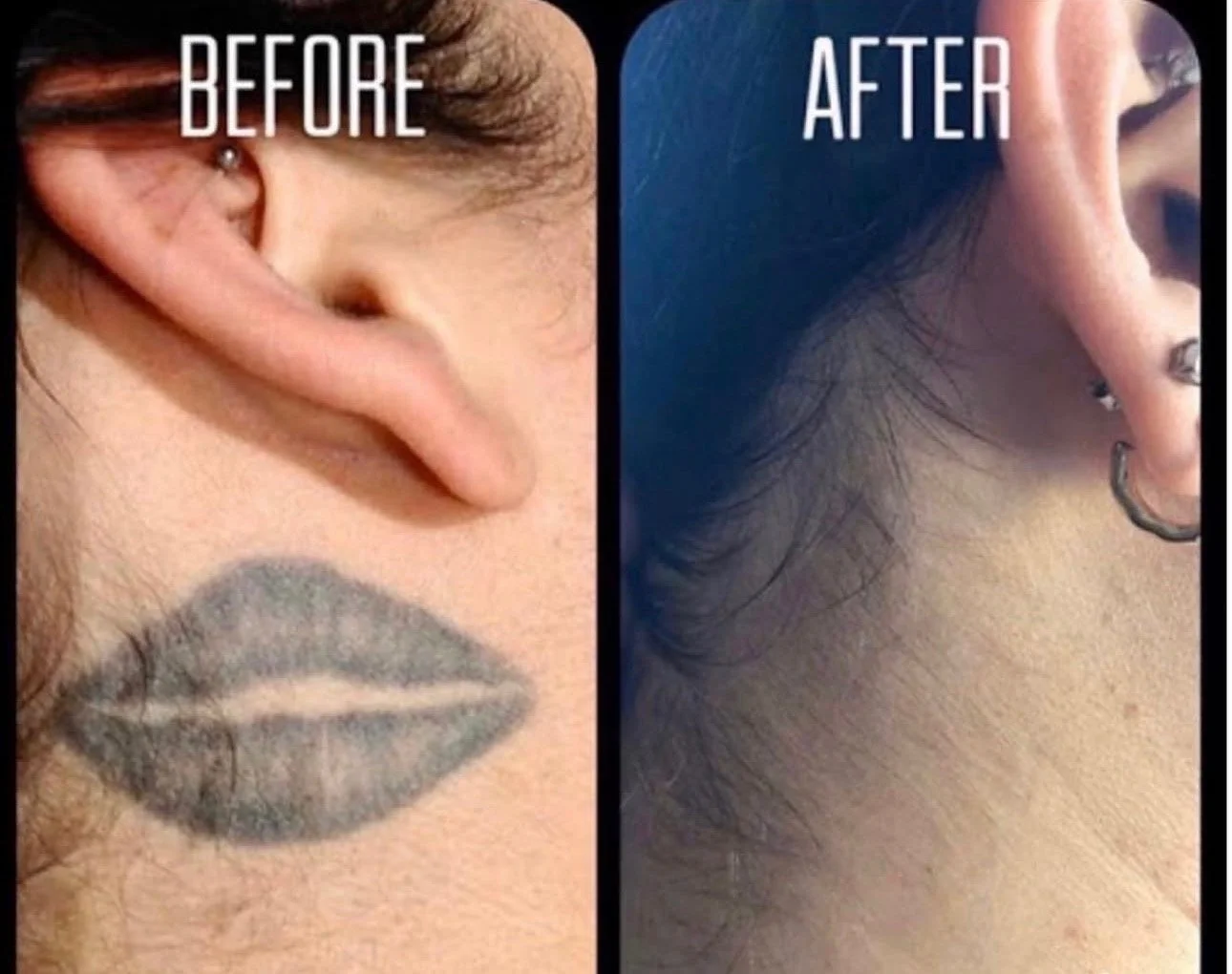Comparison of an ear with a lipstick kiss mark above it on the left and a clean ear on the right, labeled 'Before' and 'After'.