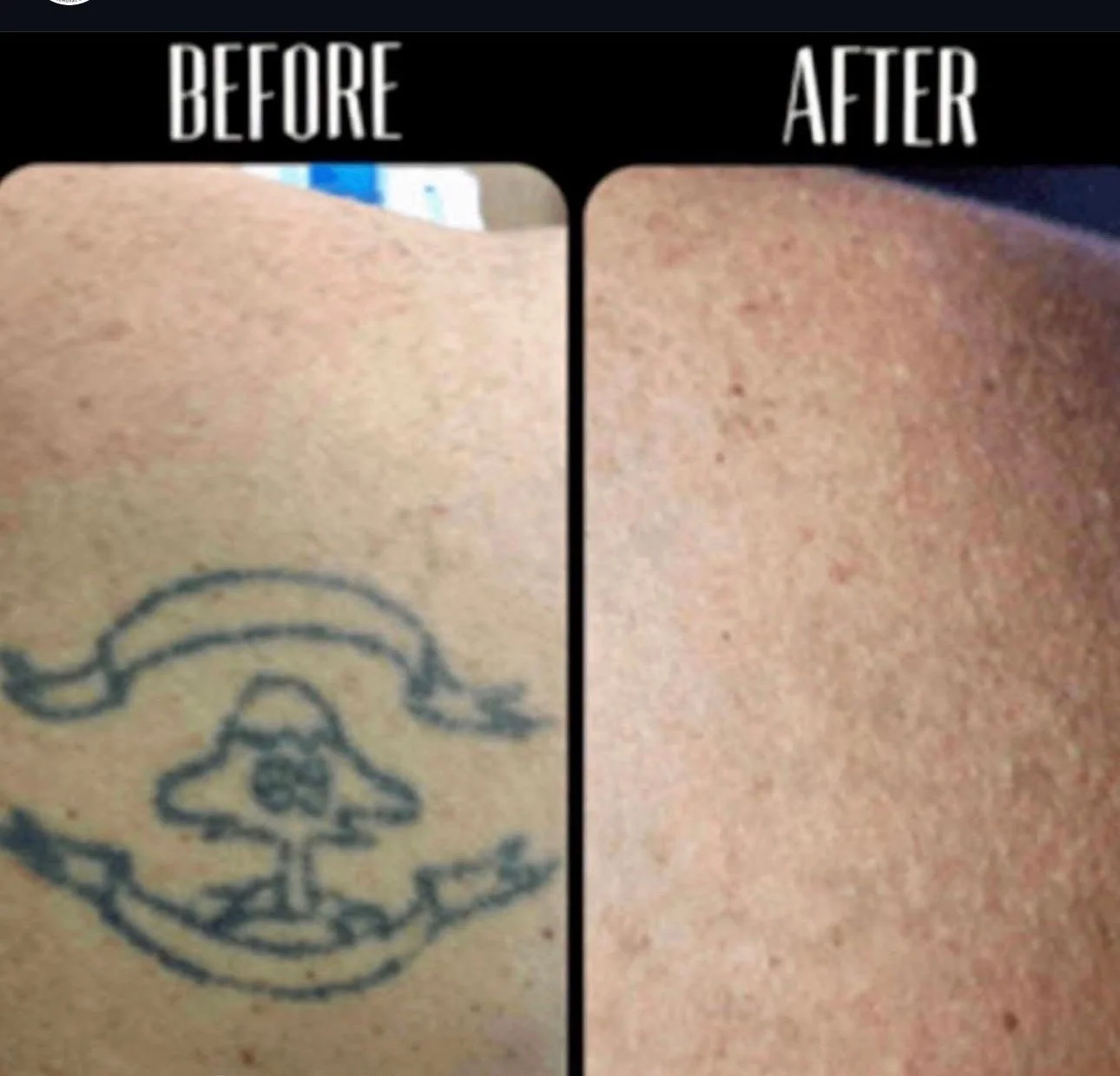 Comparison of skin before and after tattoo removal, showing a tattoo of a skull with a hat on skin.