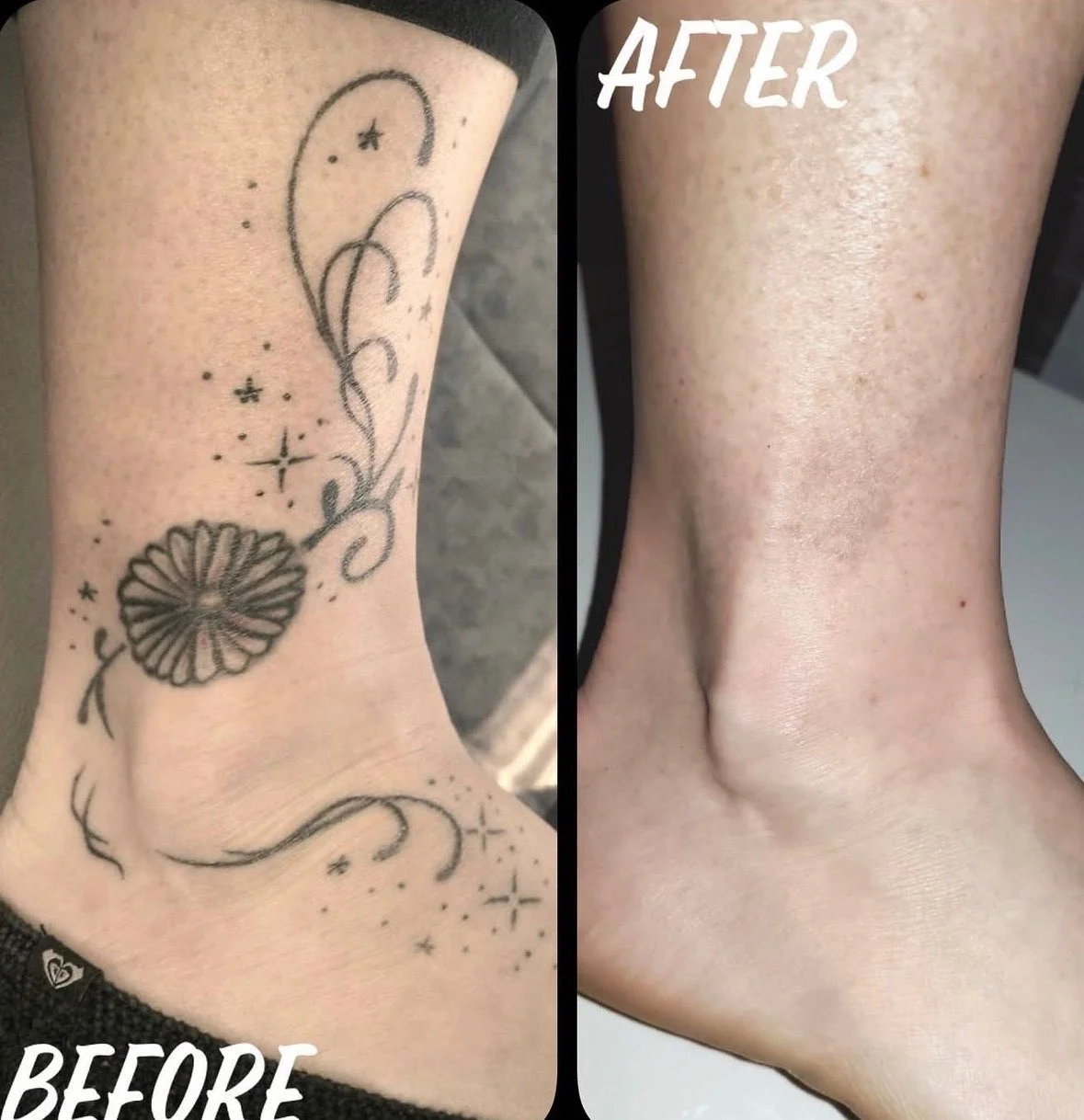 Comparison of a person's ankle and lower leg before and after tattoo removal. The left side shows a tattoo with celestial and floral elements, while the right side shows clear skin after removal.