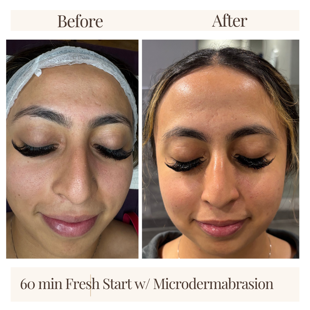 Comparison photo showing before and after microdermabrasion facial treatment. The left image shows a woman with facial redness and uneven skin texture, wearing a headband. The right image shows the same woman with smoother, clearer skin and a more even complexion, with her hair down.