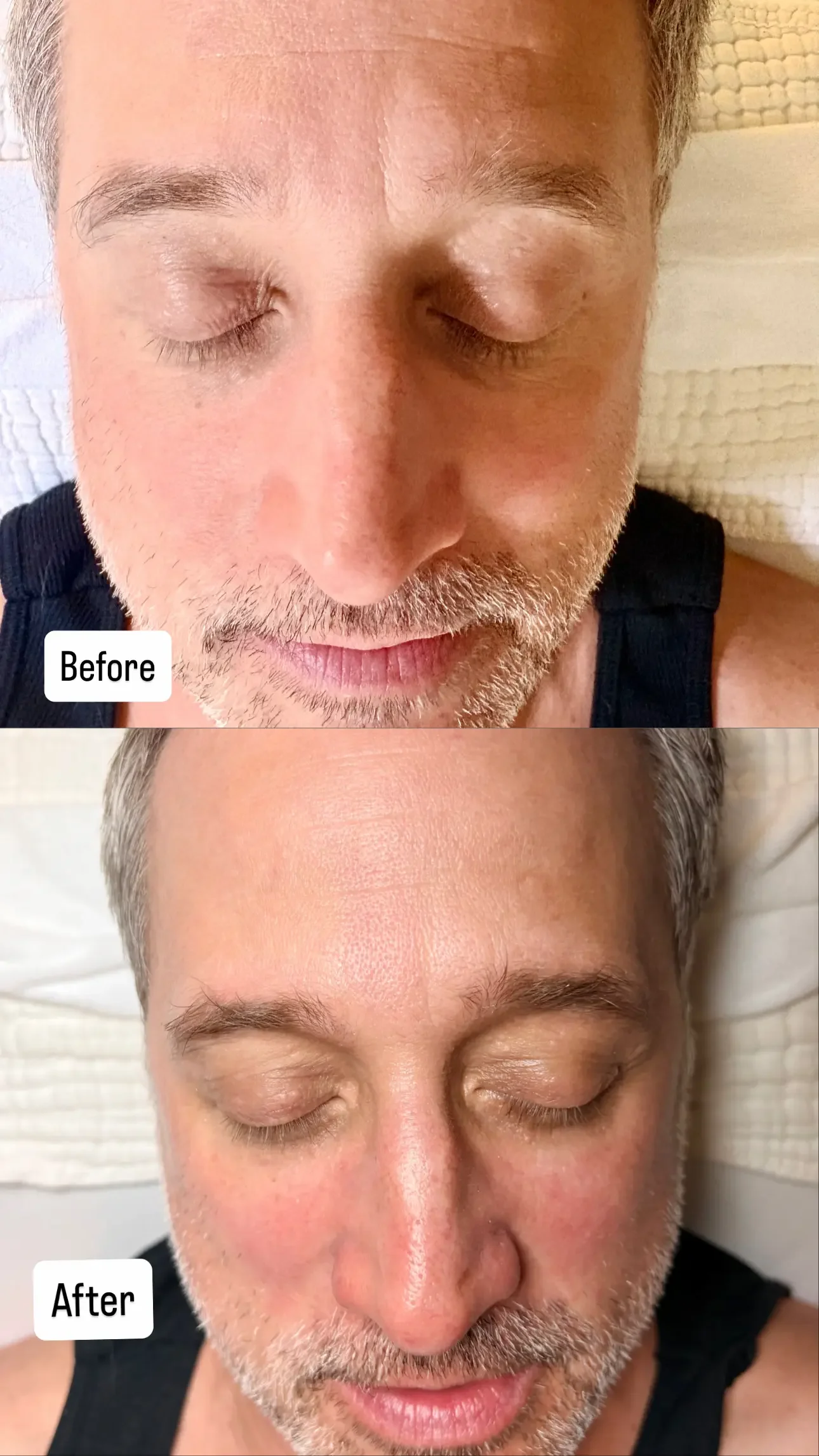 before and after, 52 year old male