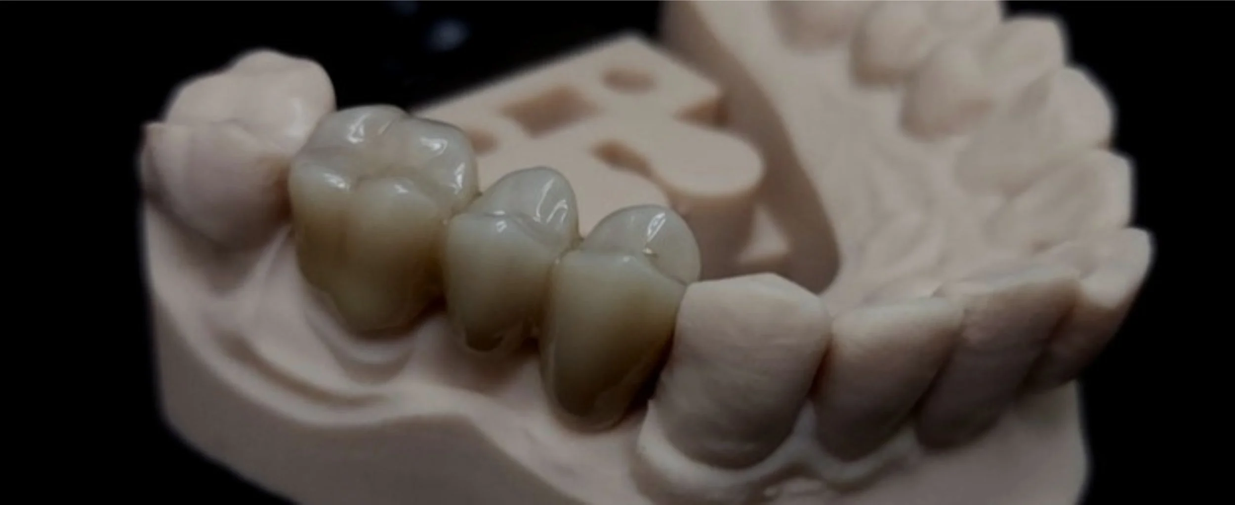 Dental model showing multiple teeth, including two molars with dental restorations