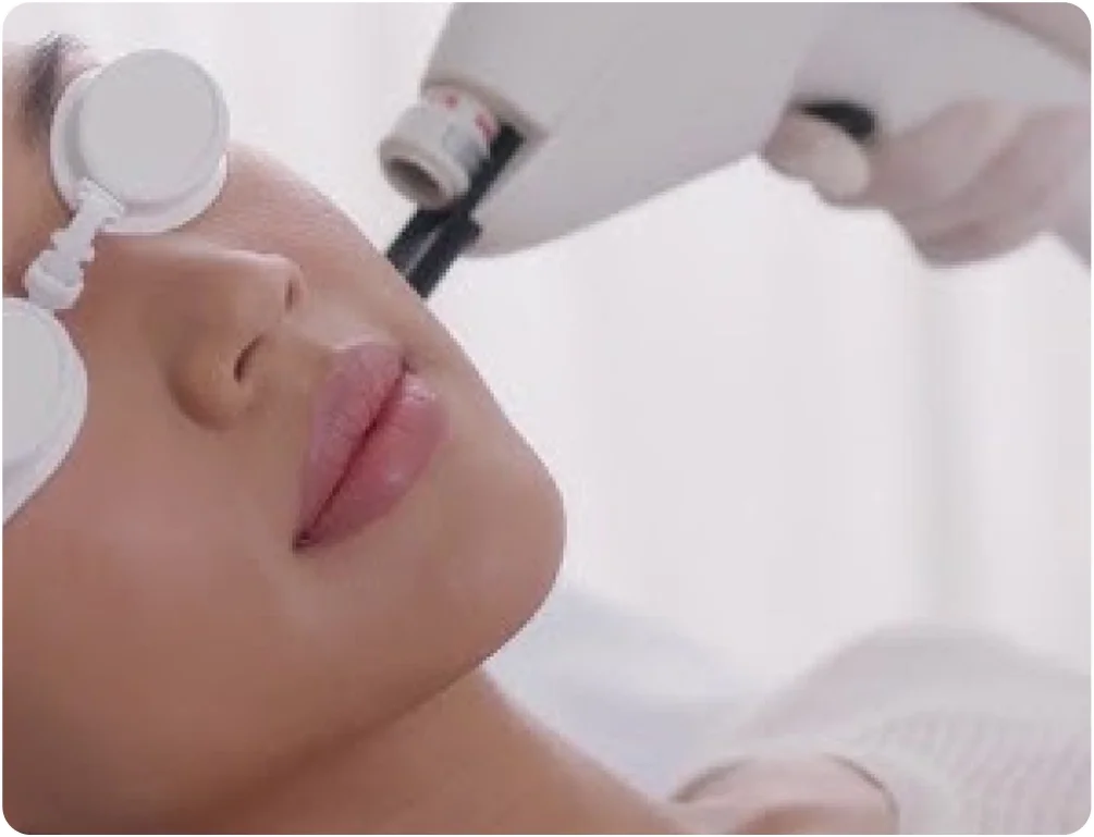 Specialised Acne Laser (Sebaceous-Targeting Laser)
