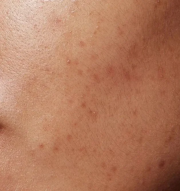 Close-up of human skin showing redness and small pimples or acne.