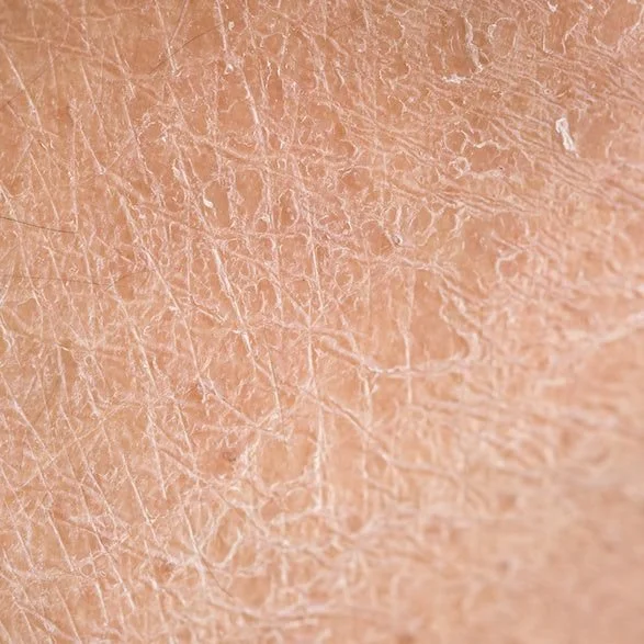 Close-up of dry, cracked skin showing detailed texture and fine lines.