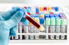Blood Test for Psoriatic Arthritis (led by Dr Steven Zhao)