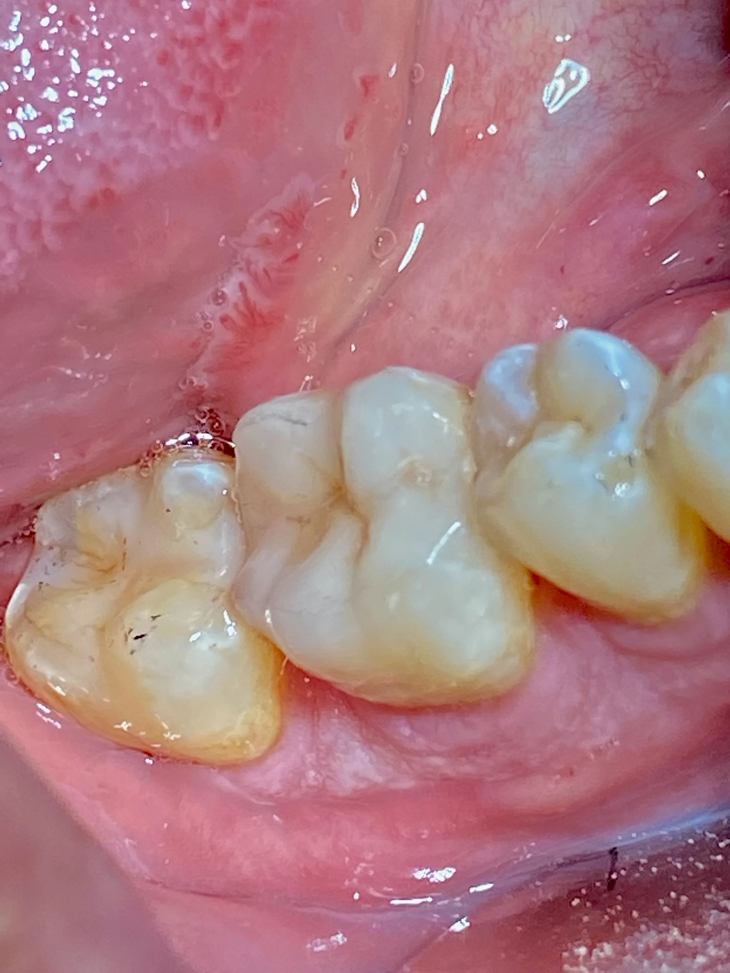 Close-up of molar tooth with porcelain onlay restoration