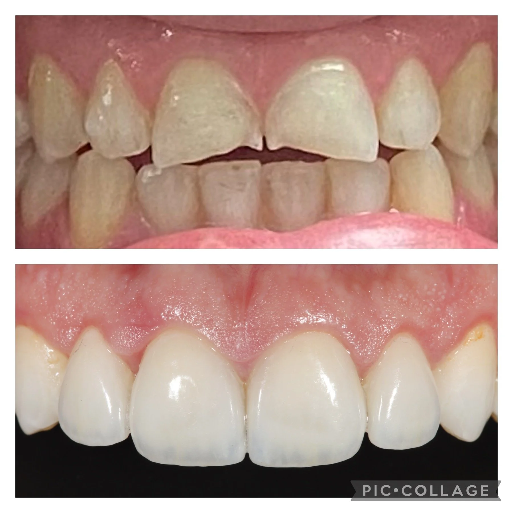 Close-up of a person's teeth before and after porcelain veneers dental treatment, showing improvement in color and alignment, restorations done by Dr. Jose Rivera-Zayas