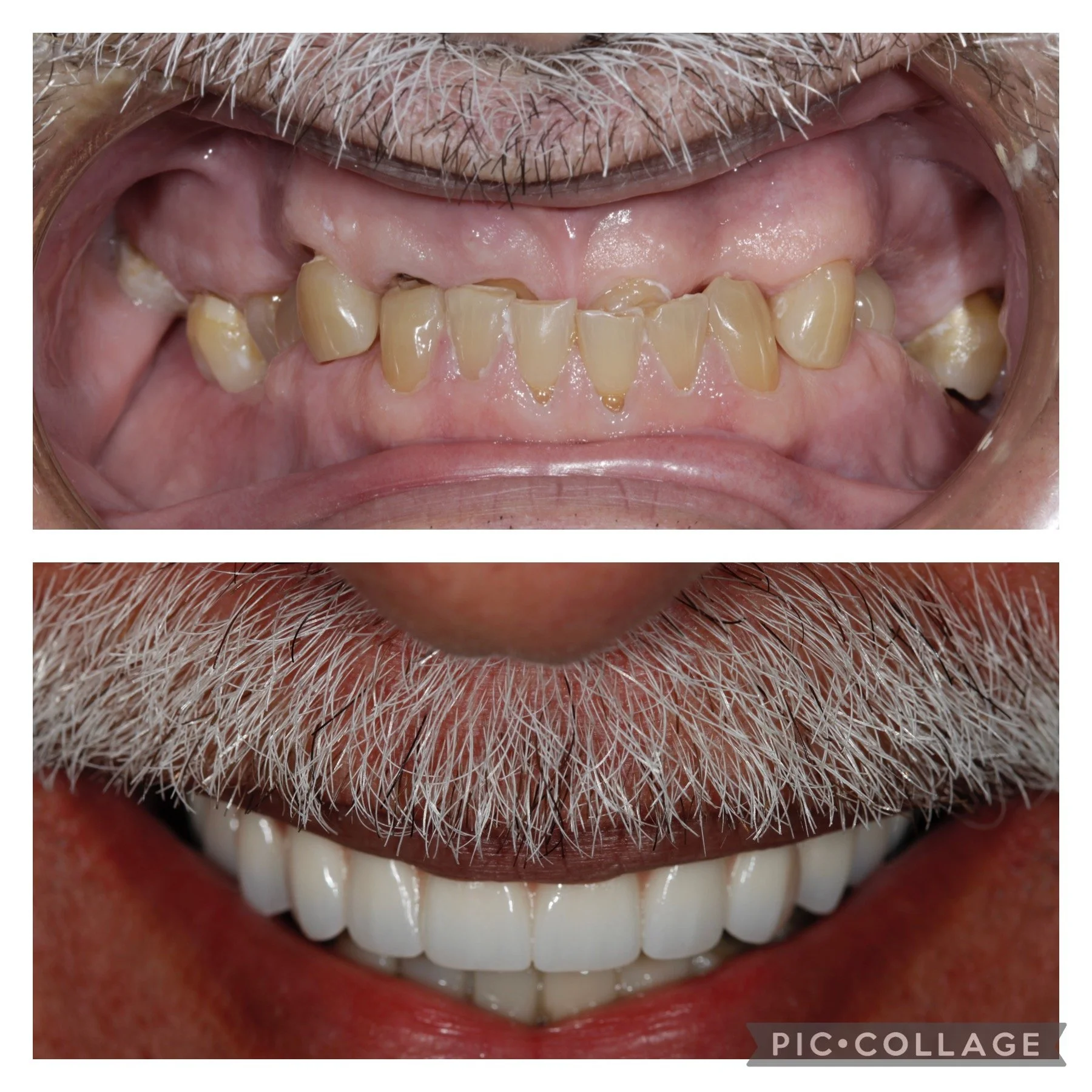 Comparison of damaged, discolored teeth in the upper jaw with a set of healthy, white teeth in a smiling man, full arch restoration done by Dr. Jose Rivera-Zayas