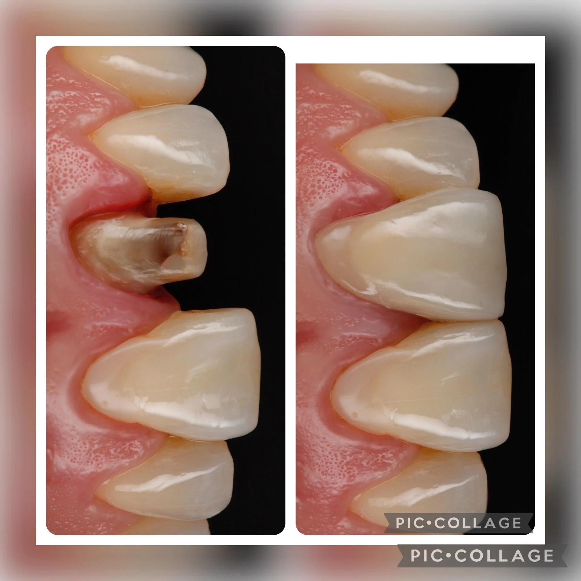 Comparison of tooth #9 prepared for porcelain crown and tooth number 9 in place barely noticeable