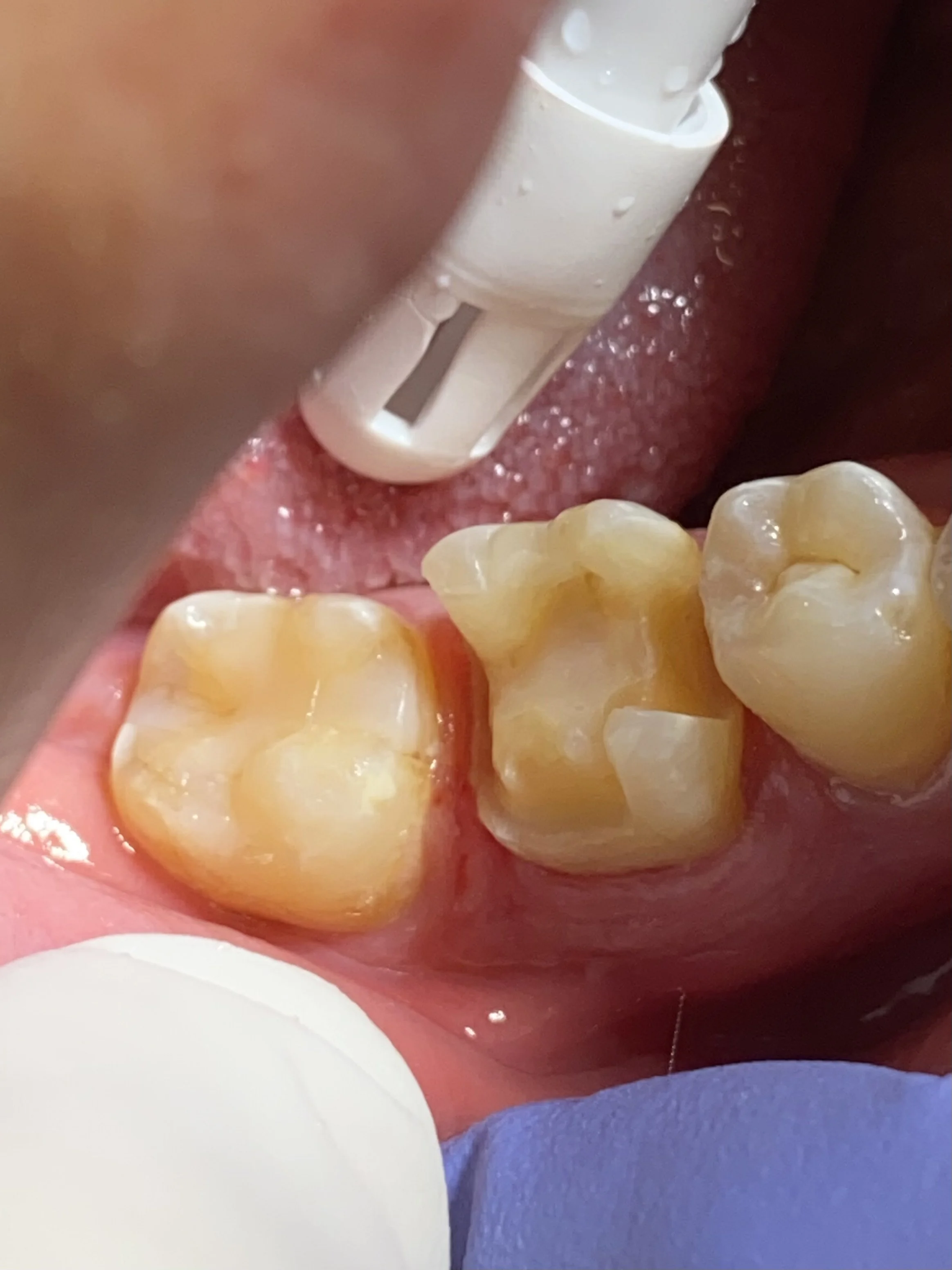 Close-up of a preparation of a molar for onlay porcelain restoration