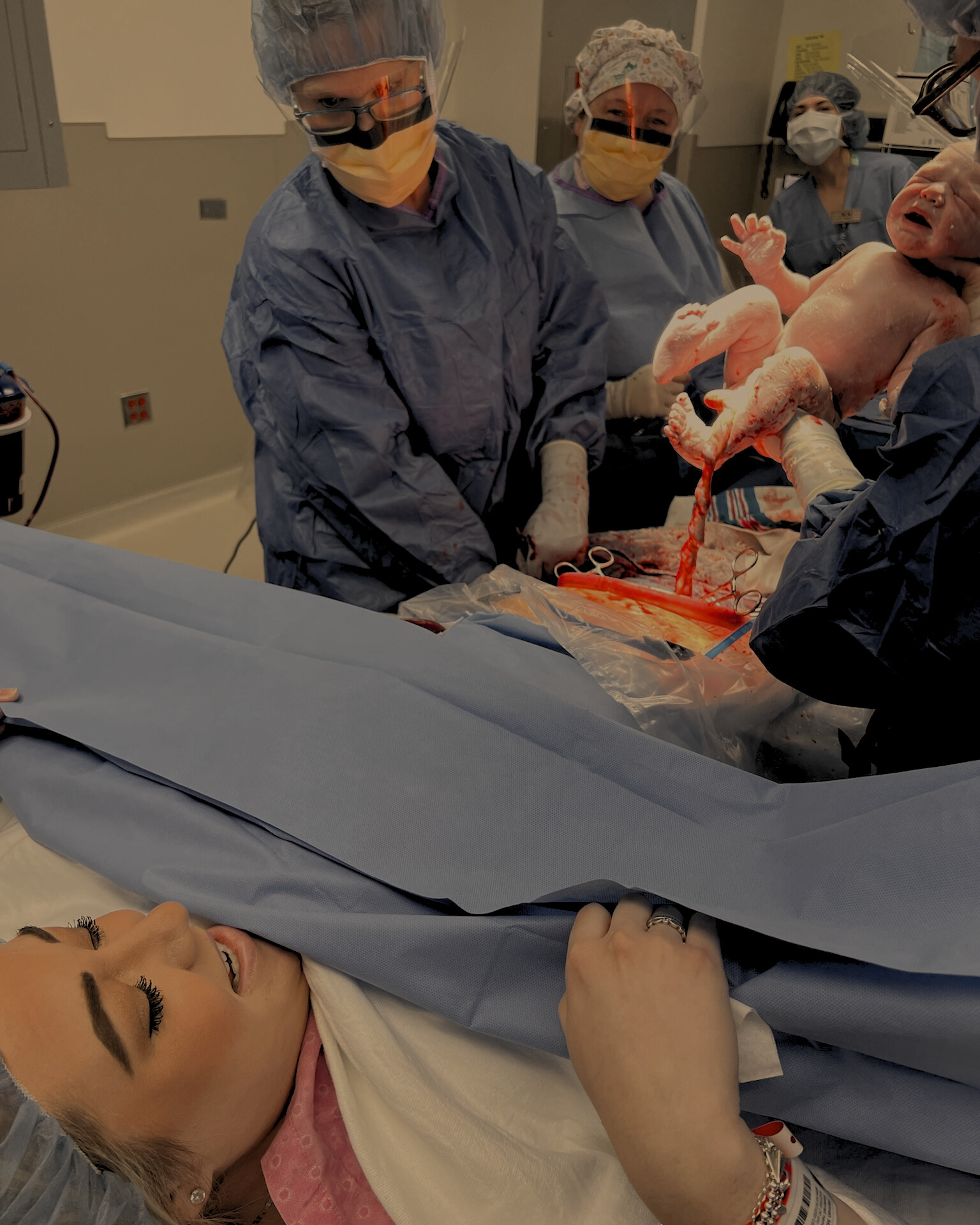 A woman lying on an operating table during childbirth, with her hand resting on her stomach. Medical professionals in scrubs and masks are performing a cesarean section, lifting a newborn baby from the mother's abdomen.