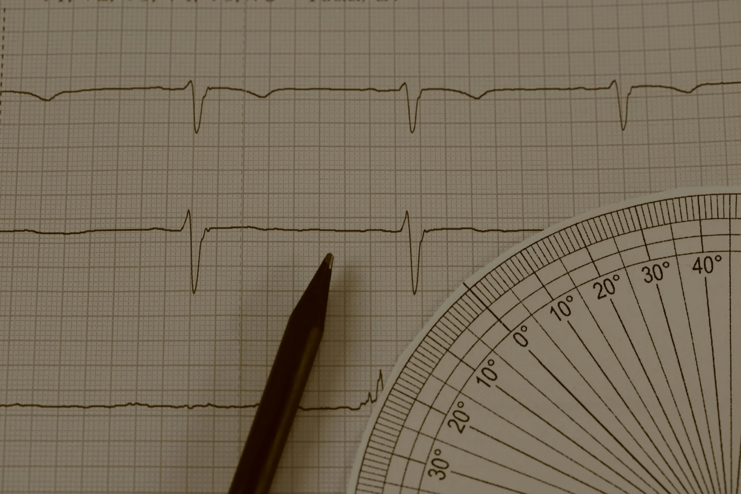 Close-up of a resting ECG trace showing clear P waves, QRS complexes, and T waves for heart rhythm analysis