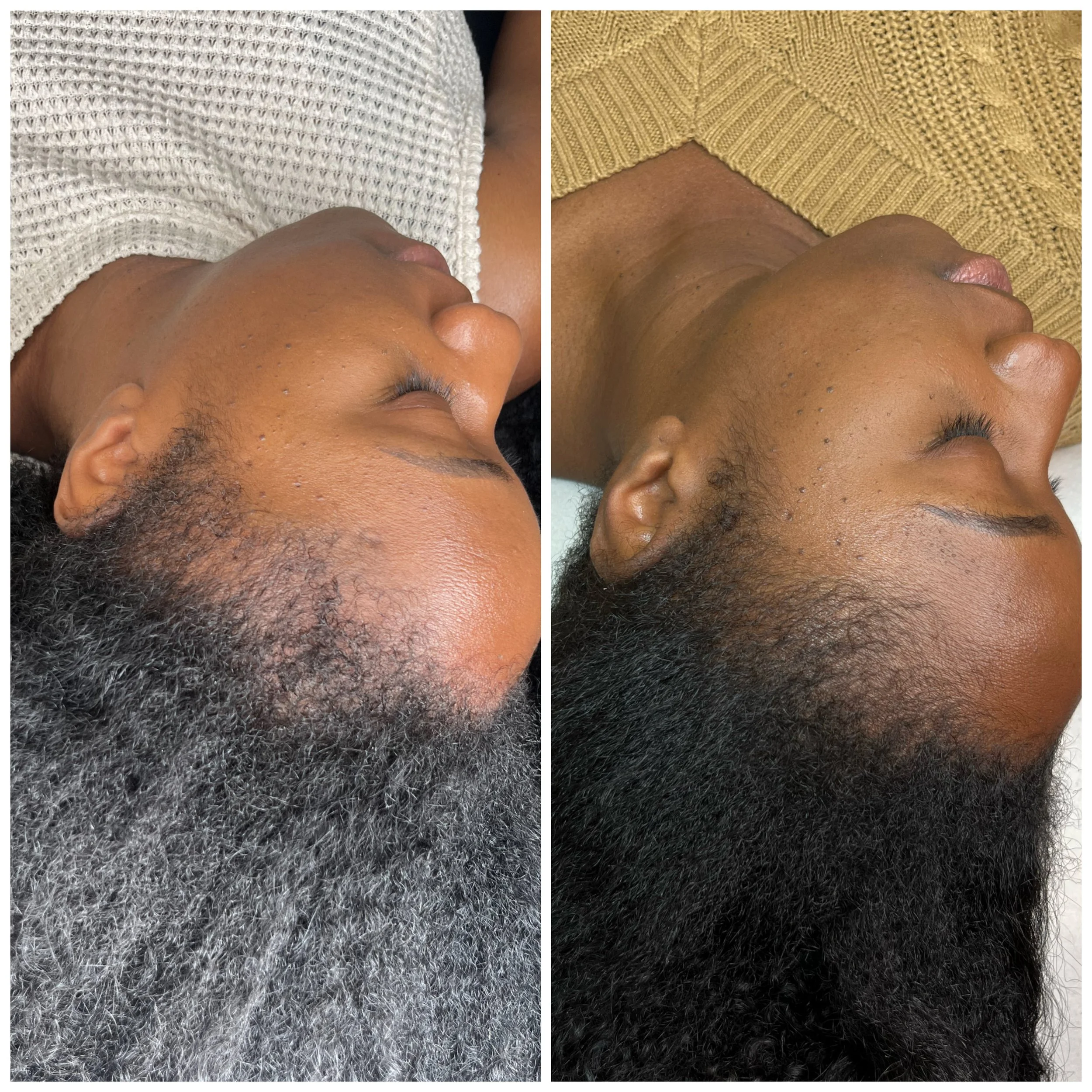 HAIRNEEDLING : SOIN DU CUIR CHEVELU