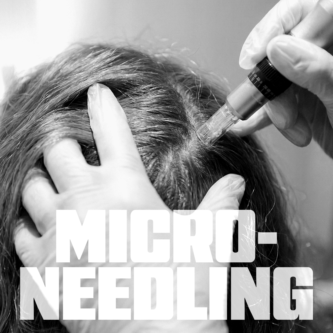 Scalp Microneedling