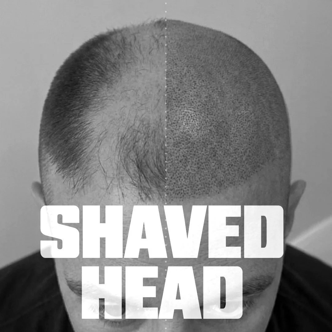 Full Hairline Restoration