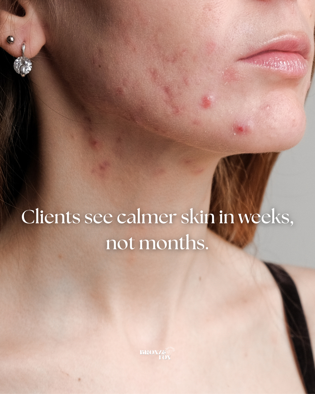 Close-up of a woman's lower face and neck showing acne scars and pimples.