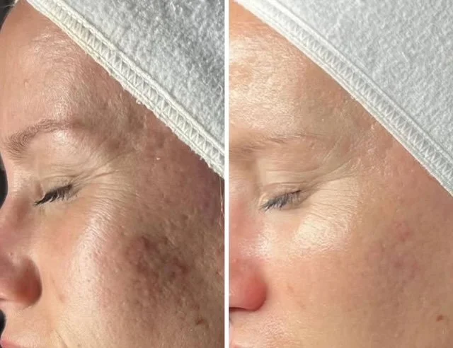 Comparison of a person's face before and after skincare, showing improved skin clarity and texture on the right side.