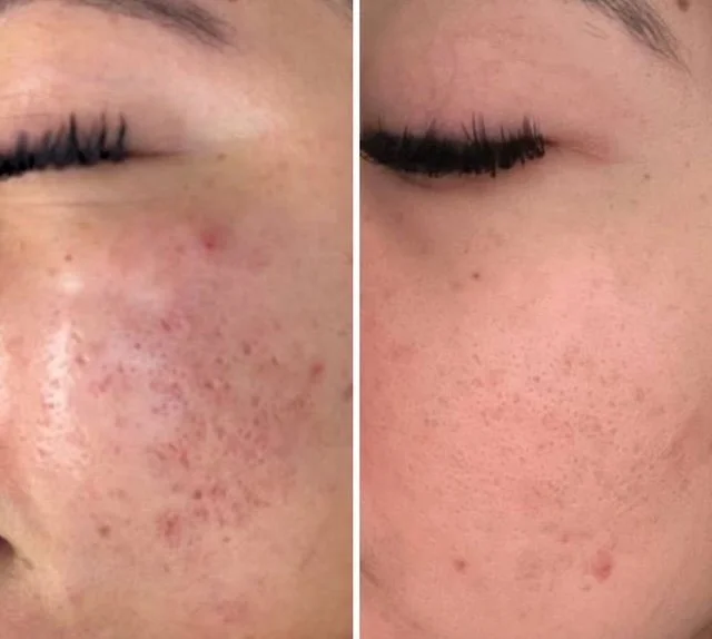 Close-up of a person's cheek showing before and after images of skin improvement, with clearer skin on the right side.