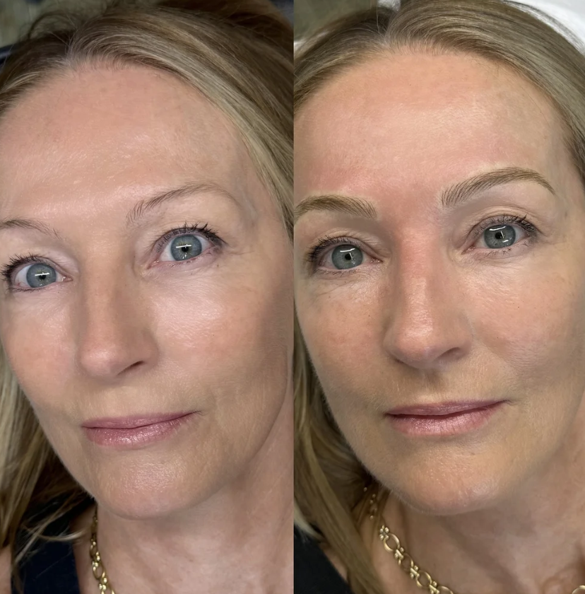 Side-by-side comparison of a woman before and after cosmetic or skincare treatment, showing improved skin texture and appearance.