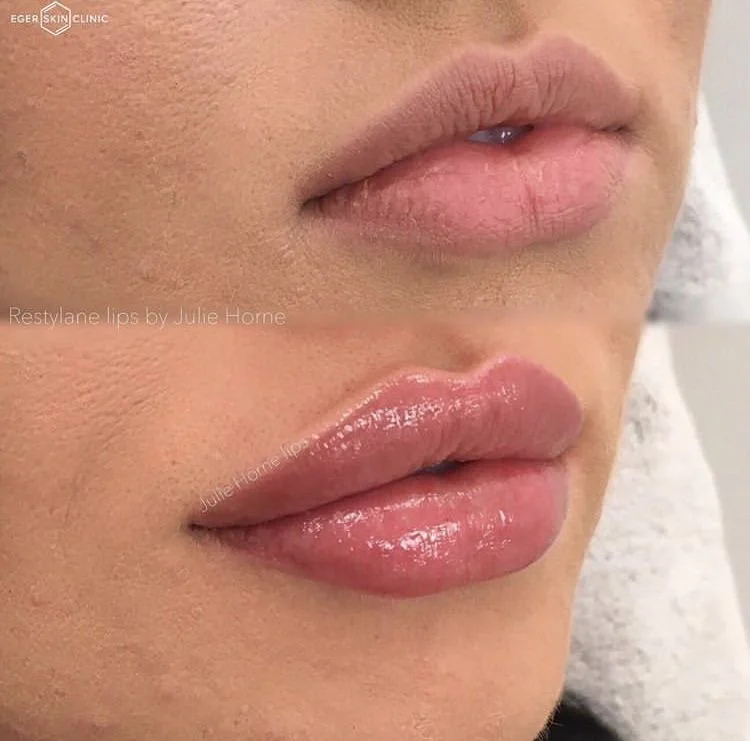 Close-up of a person's lips before and after Restylane lip enhancement, showing fuller, glossy lips in the after image.