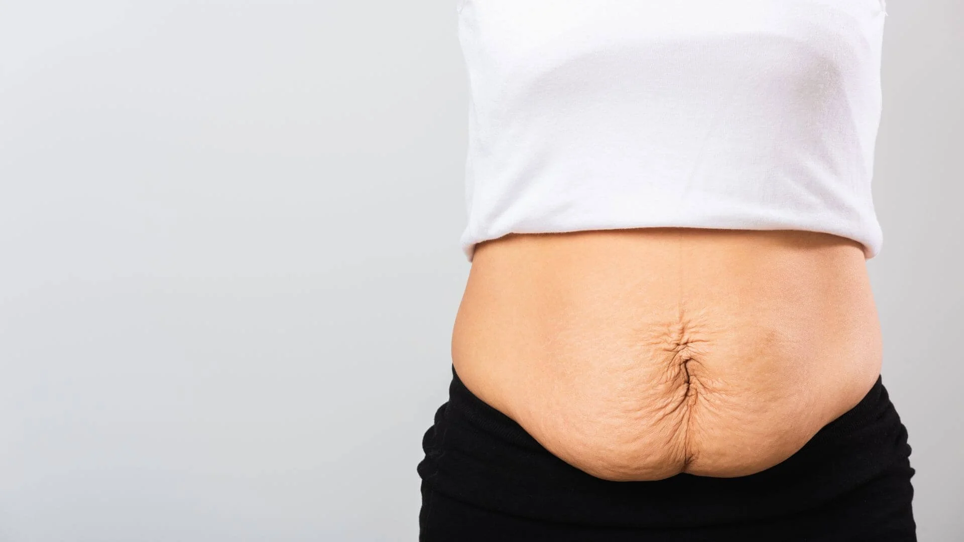 How to Fix Diastasis Recti Years Later Without Surgery