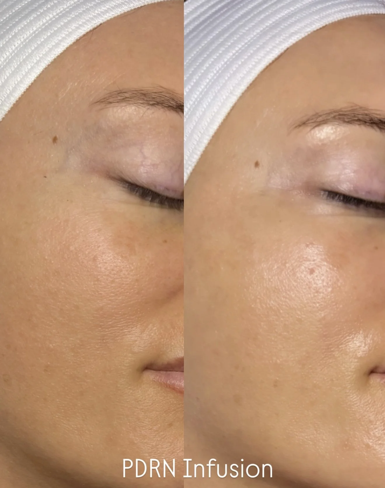 Nano-needling in Austin, TX