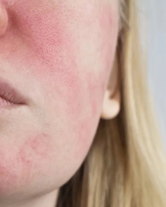Rosacea: What You Need to Know