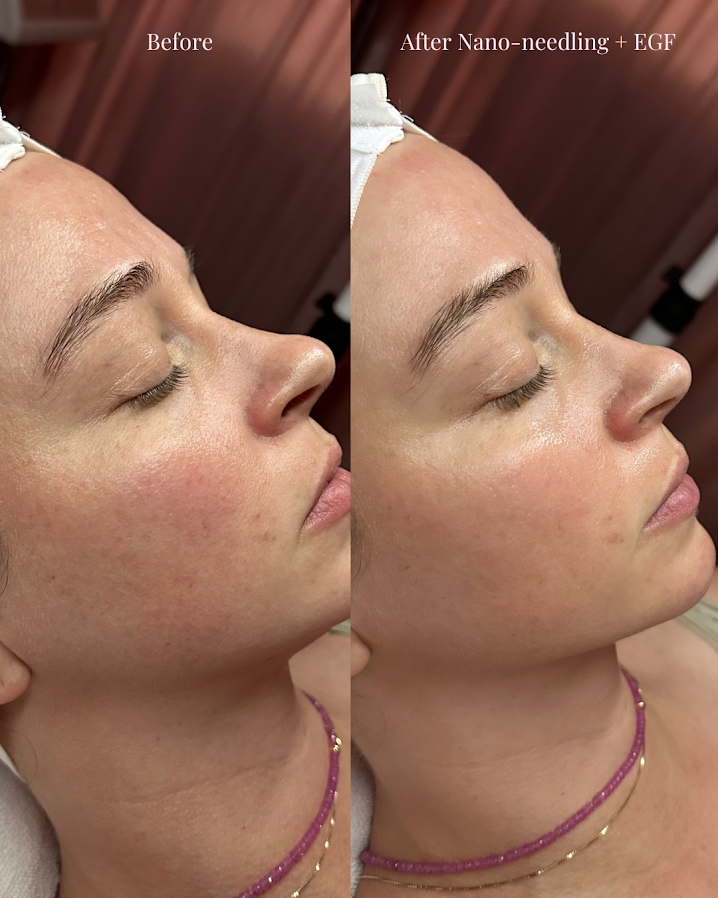 nano needling facial in austin tx at bisous esthetics egf pdrn