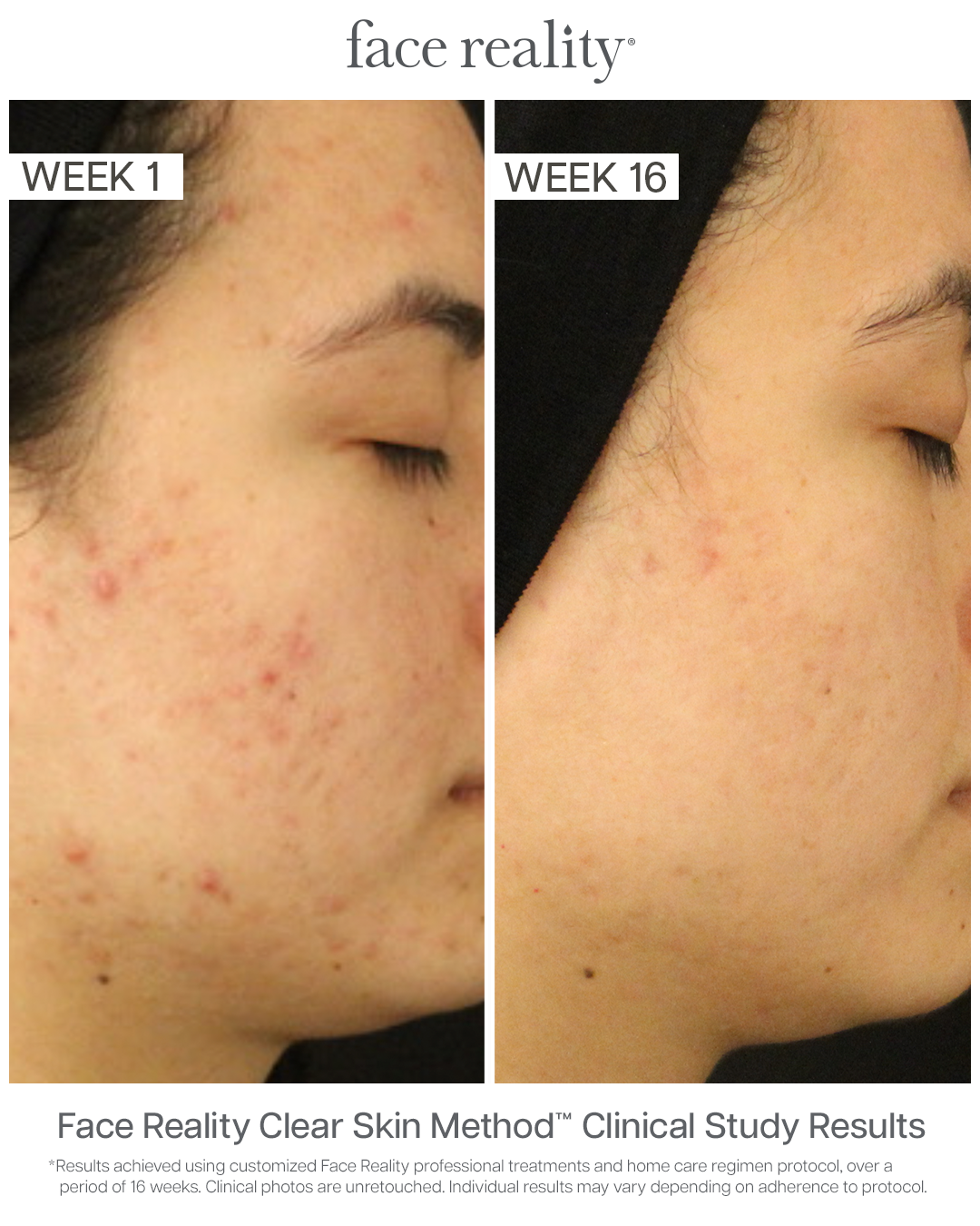 Clear Skin Journey | Personalized Acne Treatment in Austin