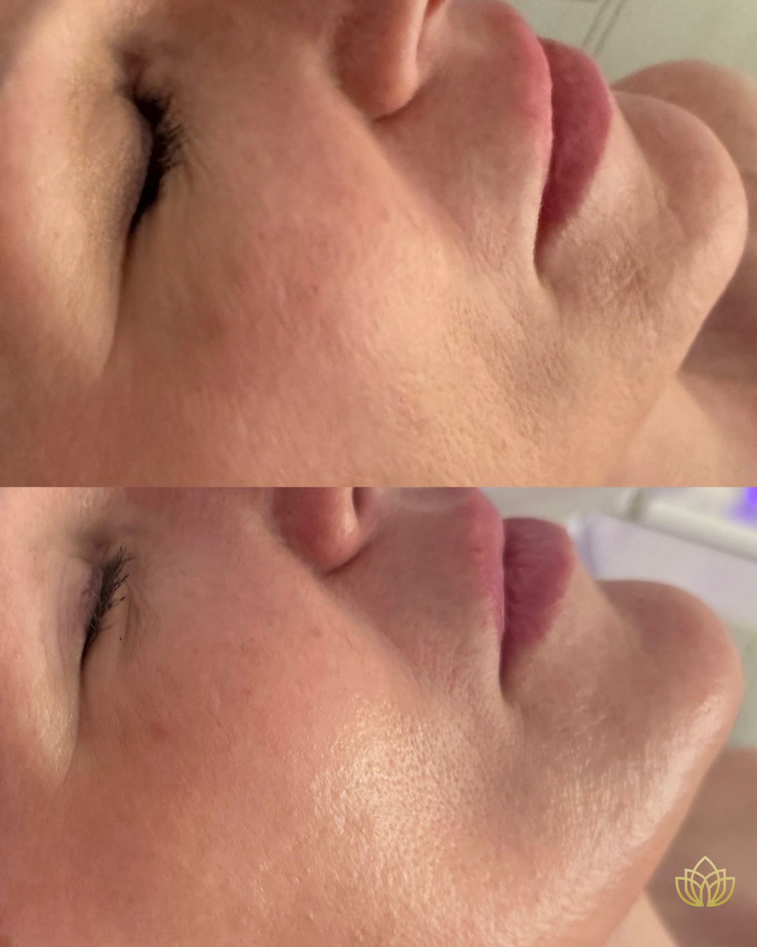 korean-facial-pdrn-microchanneling-microneedling-austin-tx-bisous-esthetics