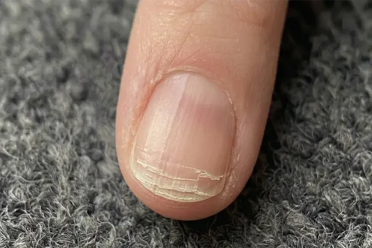 A close-up of an index fingernail with peeling layers.