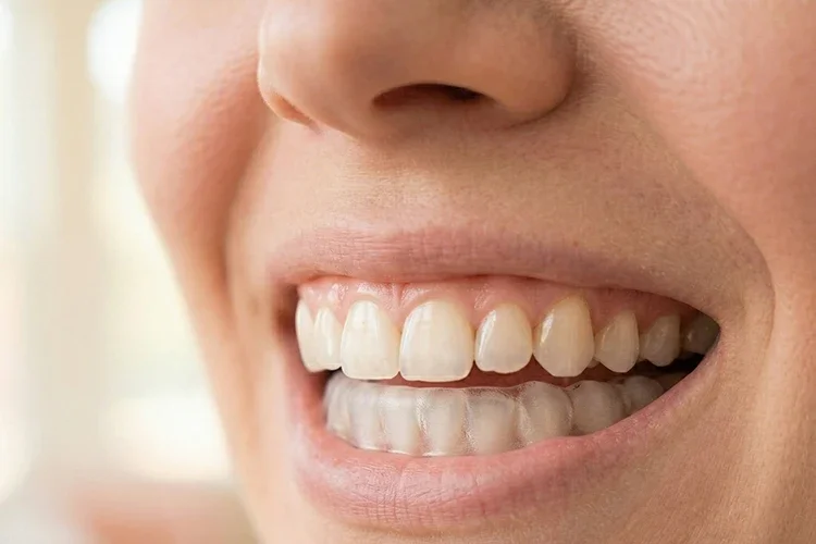 Signs You Are Grinding Your Teeth and How a Night Guard Helps