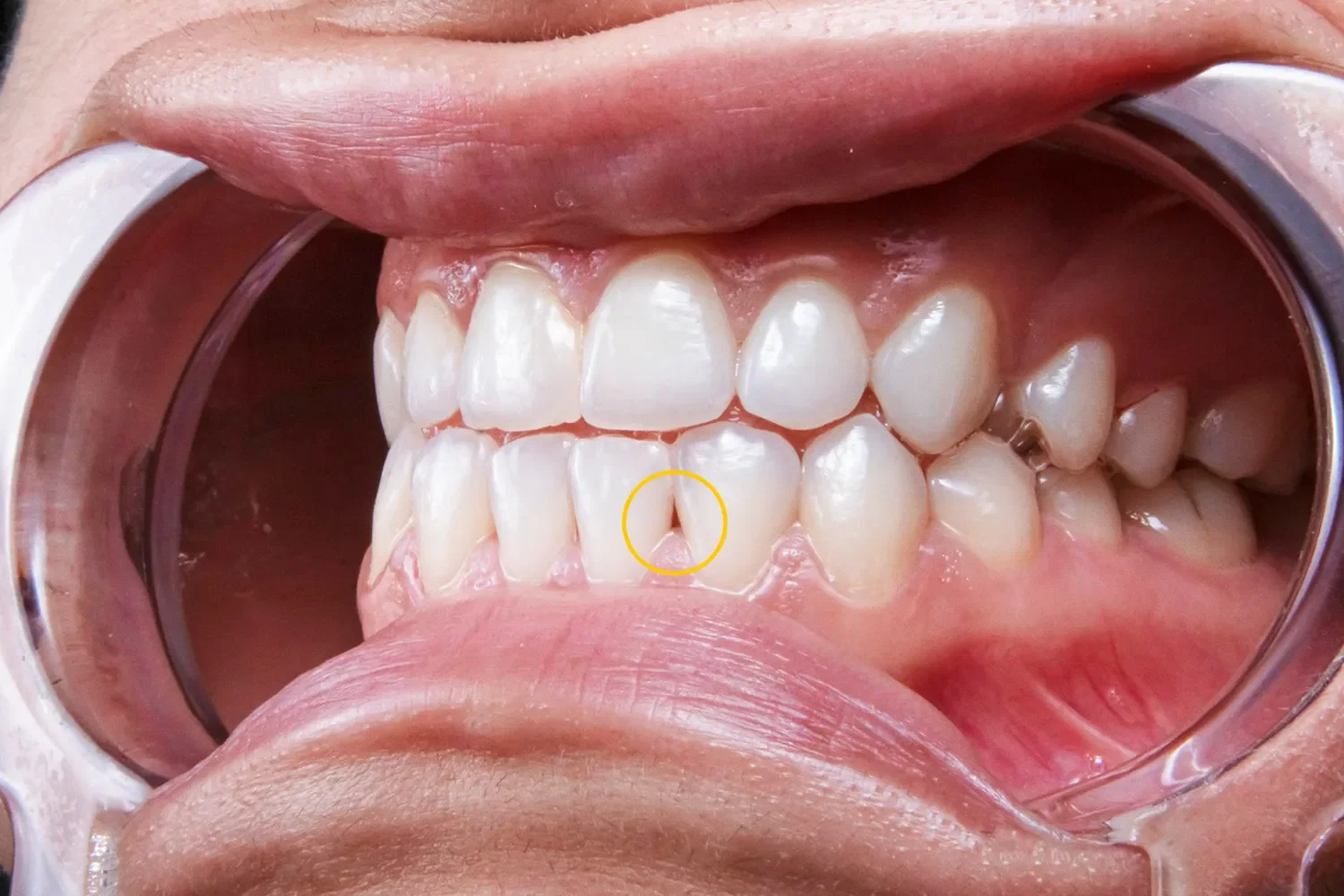Those Black Triangles Between Your Teeth Aren't Random