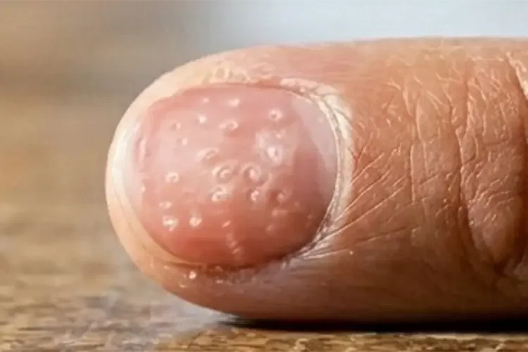 A close-up of an index fingernail with tiny pits and dents.