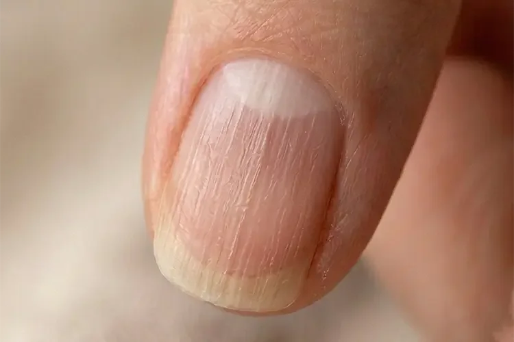 A close-up of an index fingernail with vertical ridges.