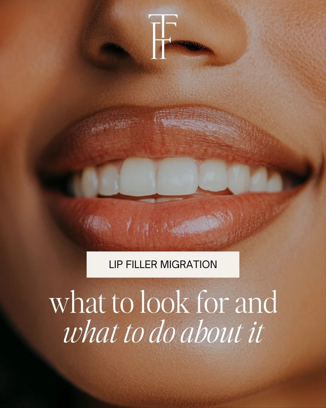 Lip filler should enhance the lips, not travel beyond them.
Lip filler migration happens when filler moves outside the natural lip border, often showing up as fullness above the lip line, a &ldquo;shelf,&rdquo; or loss of natural shape.
Common reason