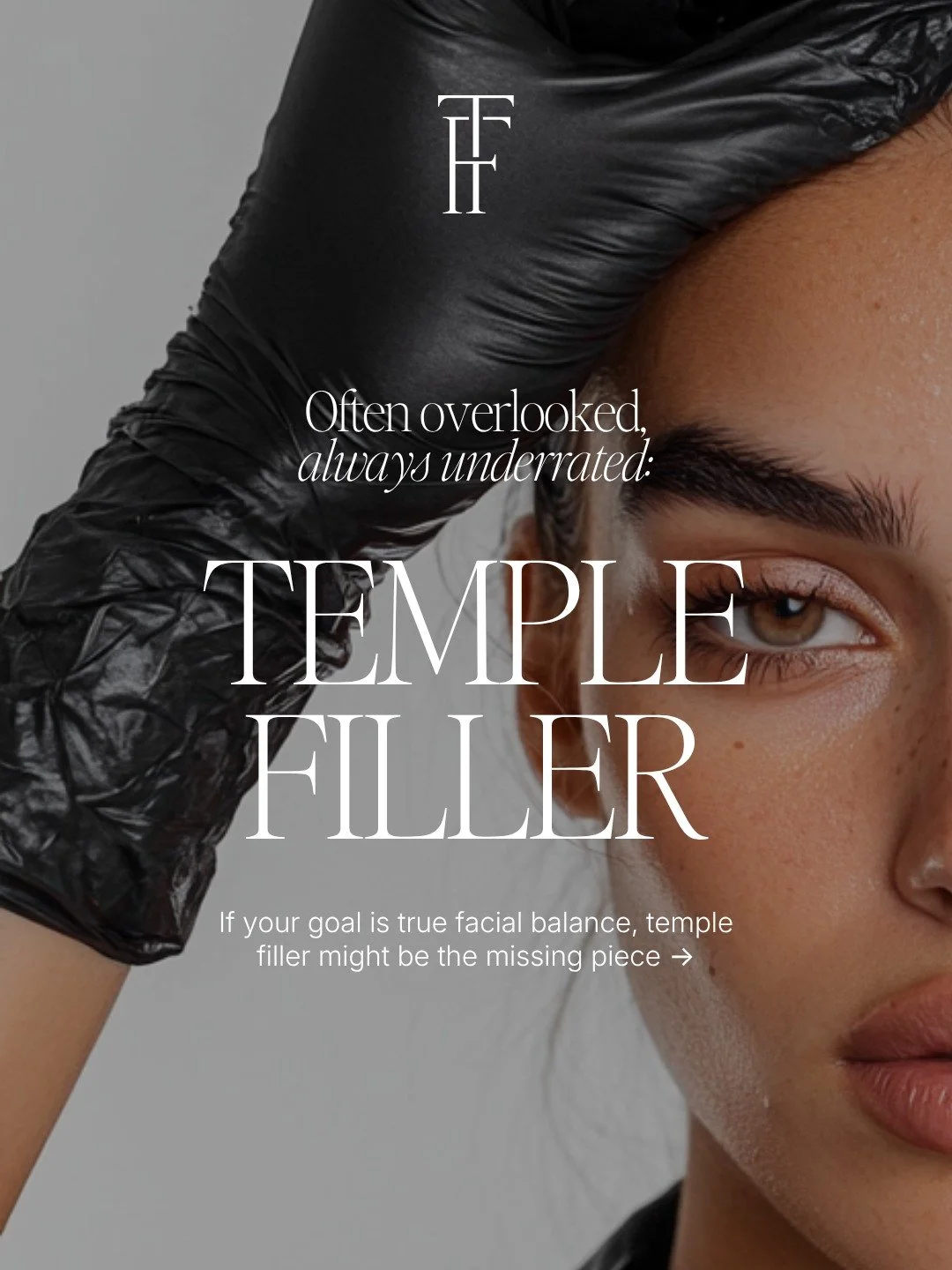 The area no one thinks about&hellip; but changes everything

Temple volume loss can make the face look:
&bull; hollow
&bull; tired
&bull; less supported overall

By restoring volume in the temples, we can create:
&bull; smoother transitions through t