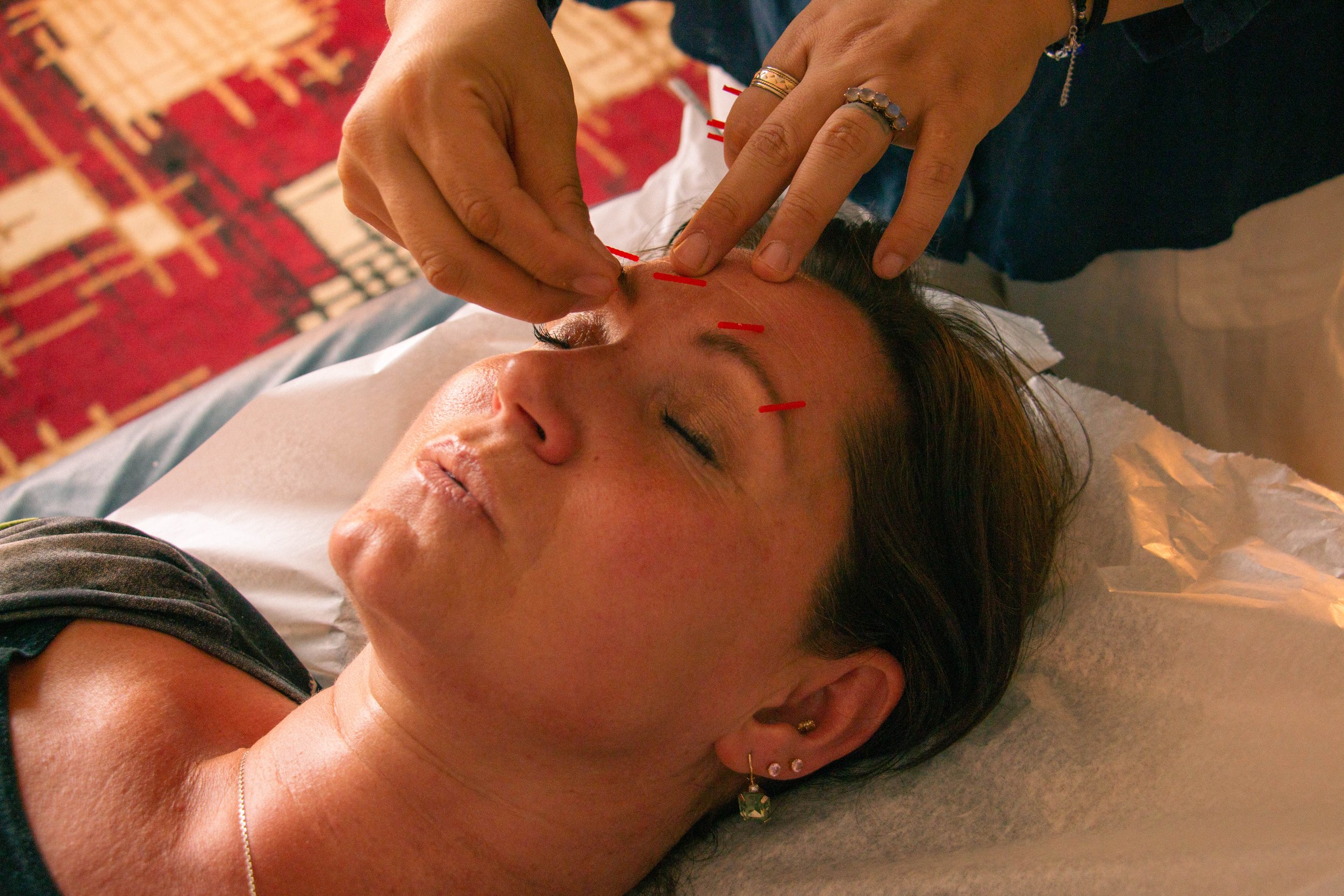 Facial Anti-Aging Acupuncture